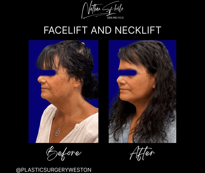 Facelift before and after case 32, actual patient at Weston Center for Plastic Surgery