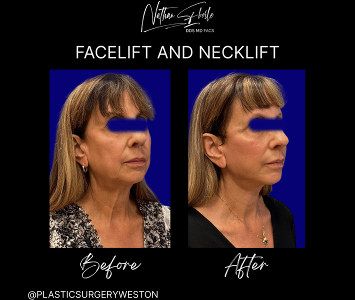 Facelift before and after case 33, actual patient at Weston Center for Plastic Surgery