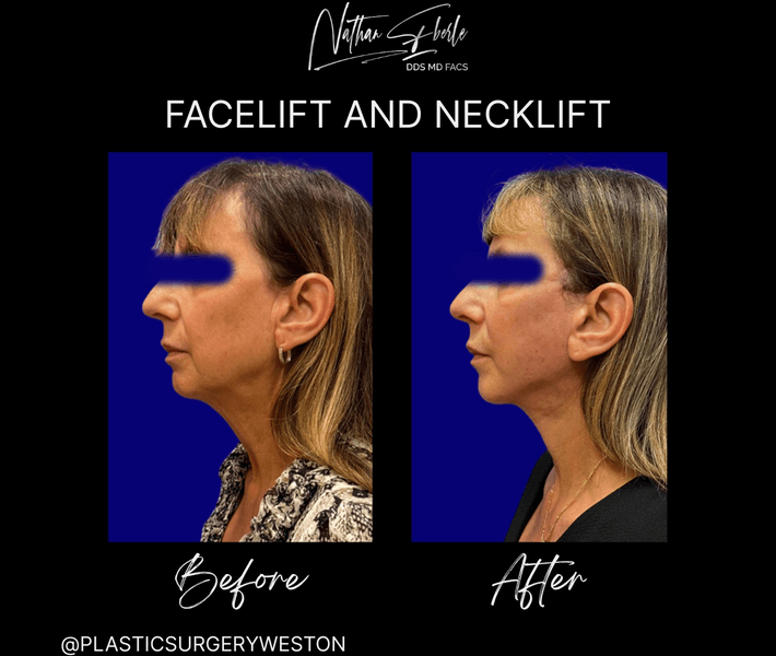 Facelift before and after case 34, actual patient at Weston Center for Plastic Surgery