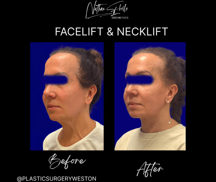 Facelift before and after case 35, actual patient at Weston Center for Plastic Surgery
