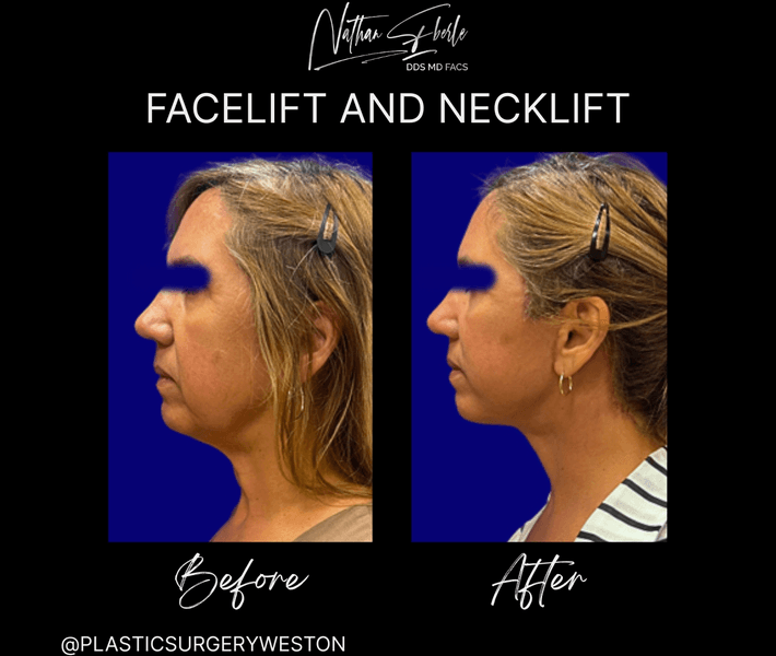 Facelift before and after case 36, actual patient at Weston Center for Plastic Surgery