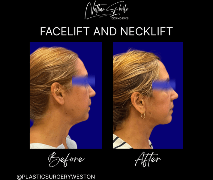 Facelift before and after case 37, actual patient at Weston Center for Plastic Surgery