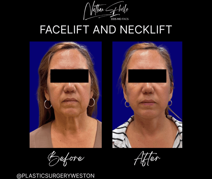 Facelift before and after case 38, actual patient at Weston Center for Plastic Surgery