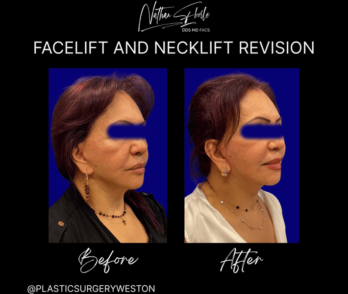 Facelift before and after case 39, actual patient at Weston Center for Plastic Surgery