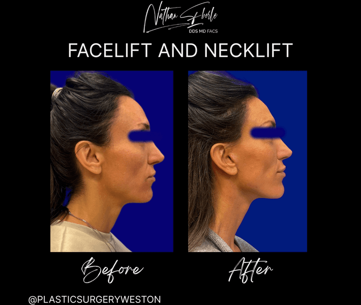 Facelift before and after case 40, actual patient at Weston Center for Plastic Surgery