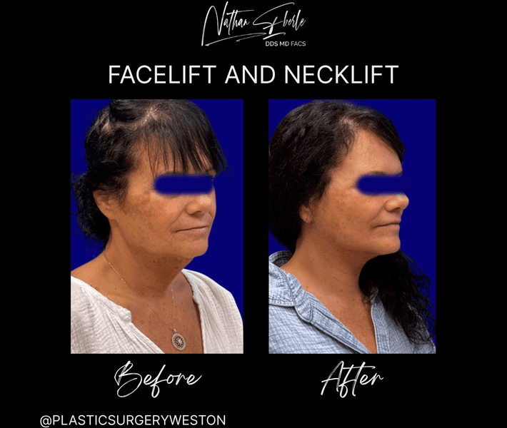 Facelift before and after case 41, actual patient at Weston Center for Plastic Surgery
