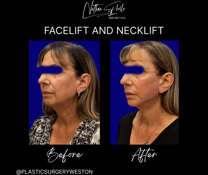 Facelift before and after case 42, actual patient at Weston Center for Plastic Surgery