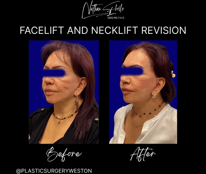 Facelift before and after case 43, actual patient at Weston Center for Plastic Surgery