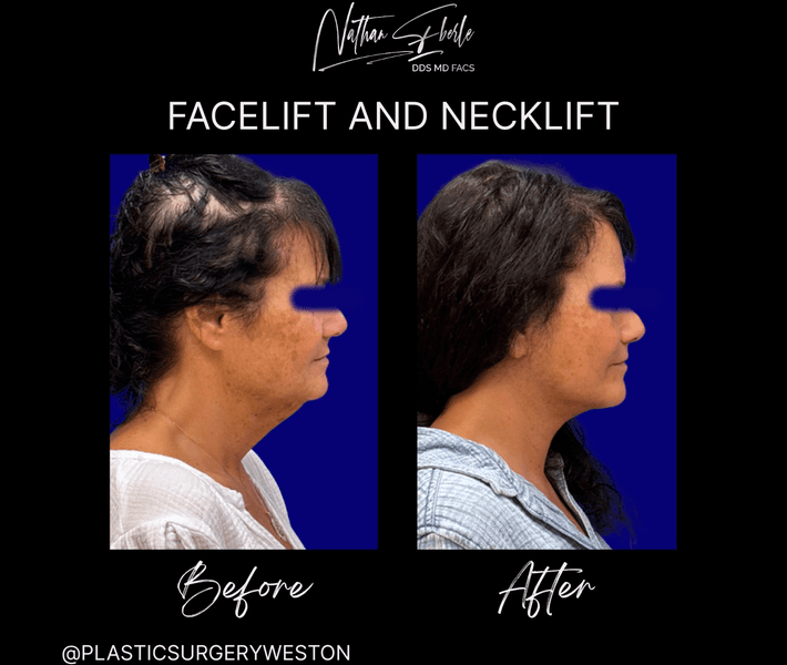 Facelift before and after case 44, actual patient at Weston Center for Plastic Surgery