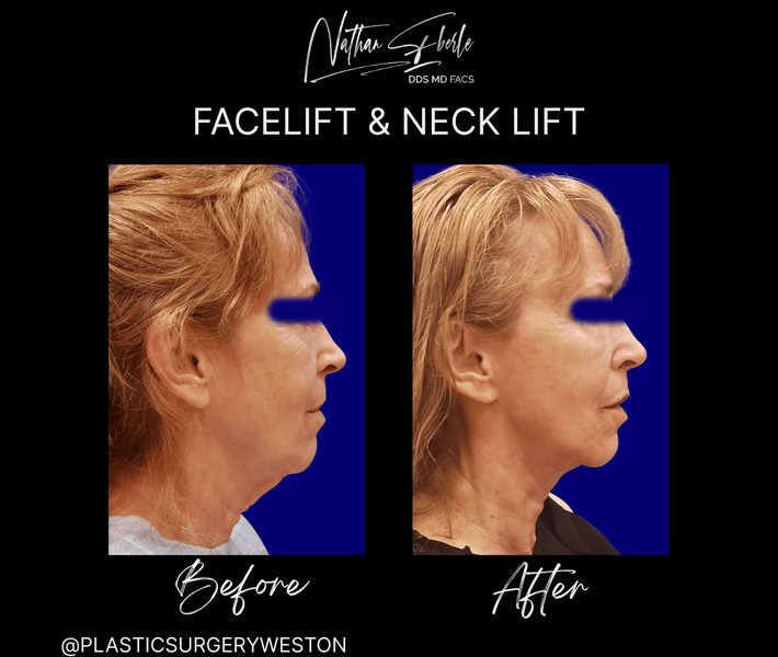 Facelift before and after case 45, actual patient at Weston Center for Plastic Surgery