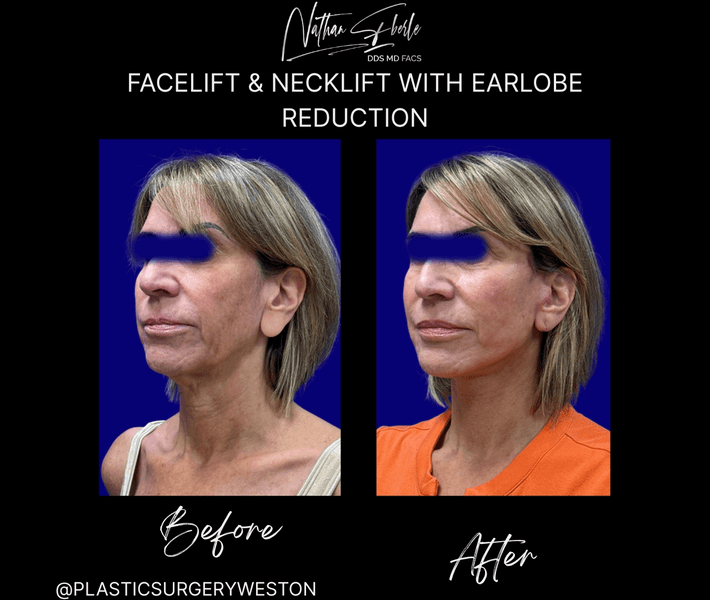Facelift before and after case 46, actual patient at Weston Center for Plastic Surgery
