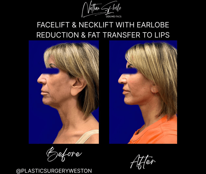 Facelift before and after case 47, actual patient at Weston Center for Plastic Surgery
