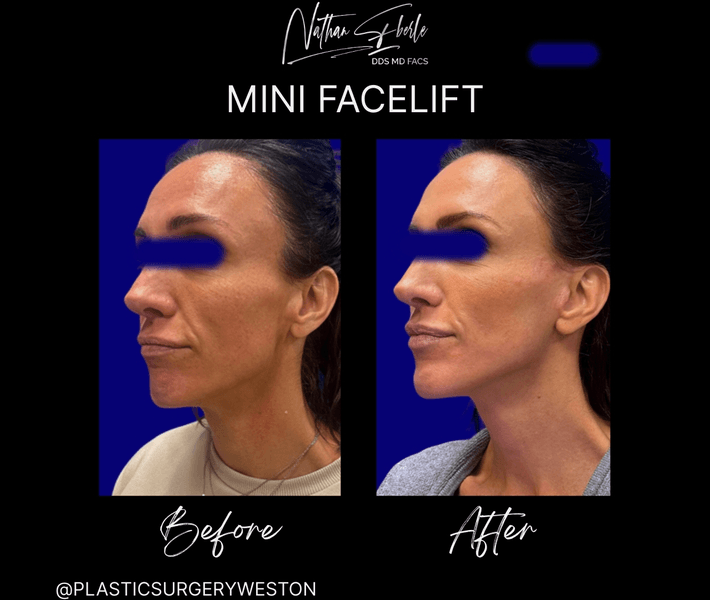 Facelift before and after case 48, actual patient at Weston Center for Plastic Surgery