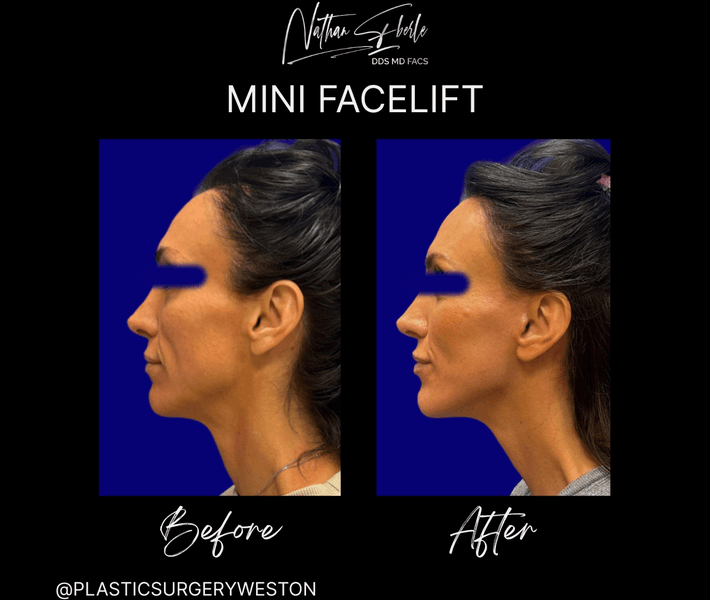 Facelift before and after case 49, actual patient at Weston Center for Plastic Surgery