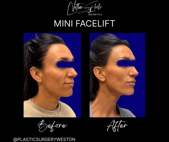 Facelift before and after case 50, actual patient at Weston Center for Plastic Surgery