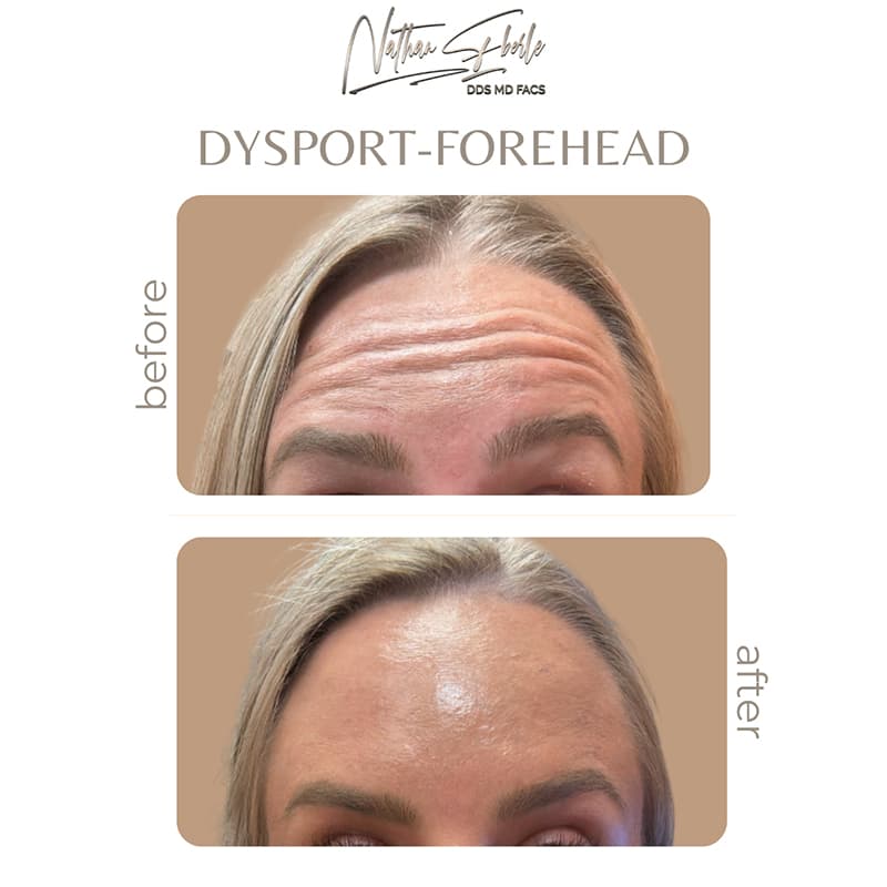 Botox case 1 before and after