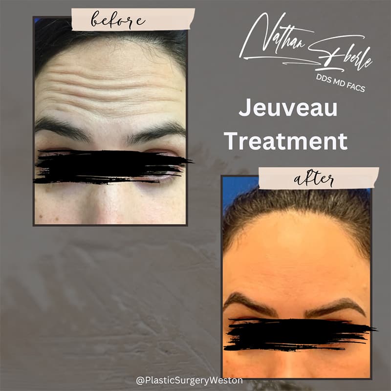Botox case 2 before and after