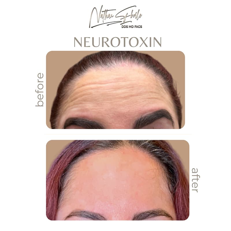 Botox case 3 before and after