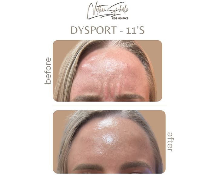 Botox case 4 before and after