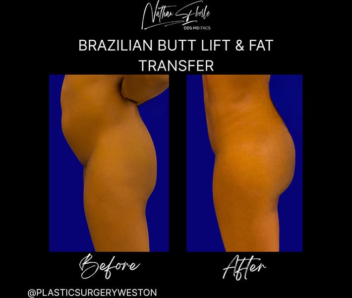 Brazilian butt lift case 2 before and after