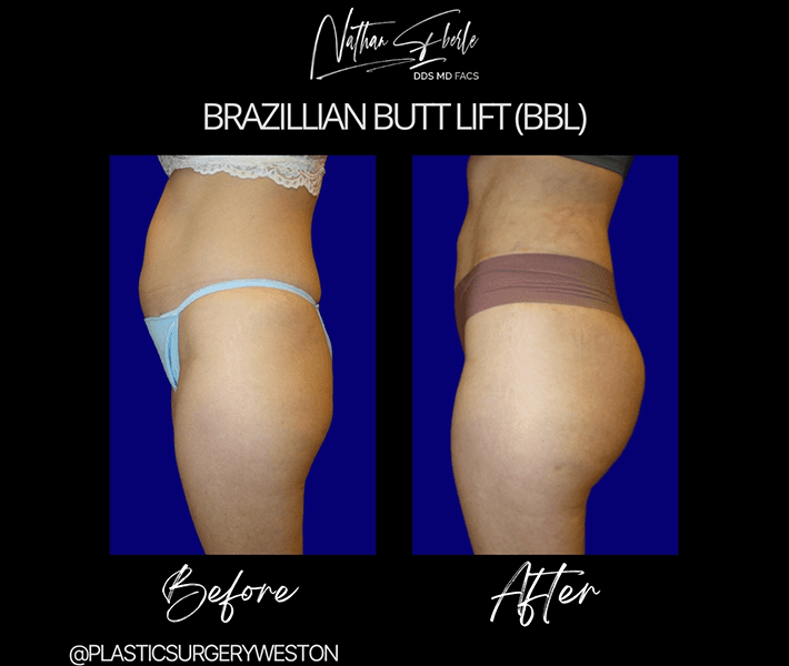 Brazilian butt lift case 3 before and after