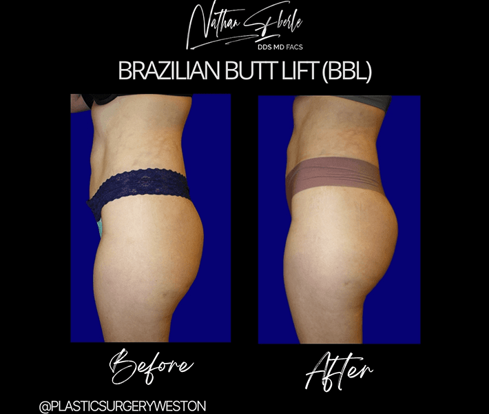 Brazilian butt lift case 4 before and after