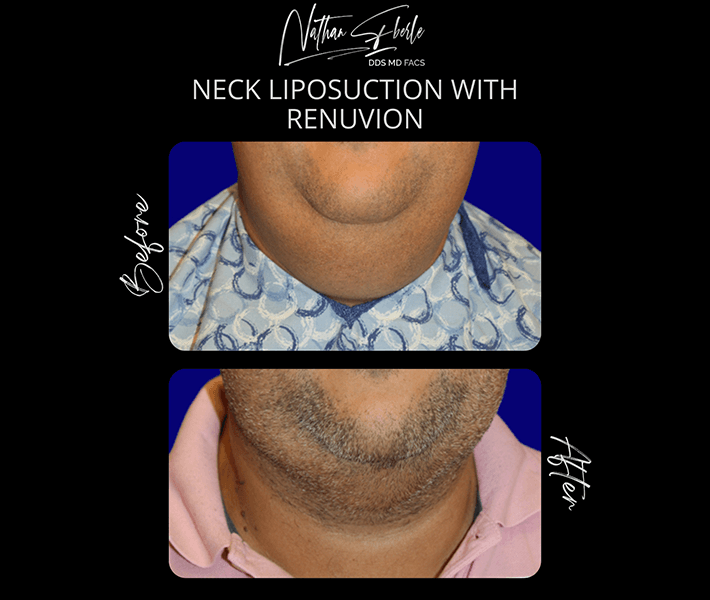 Liposuction before and after case 13, actual patient at Weston Center for Plastic Surgery