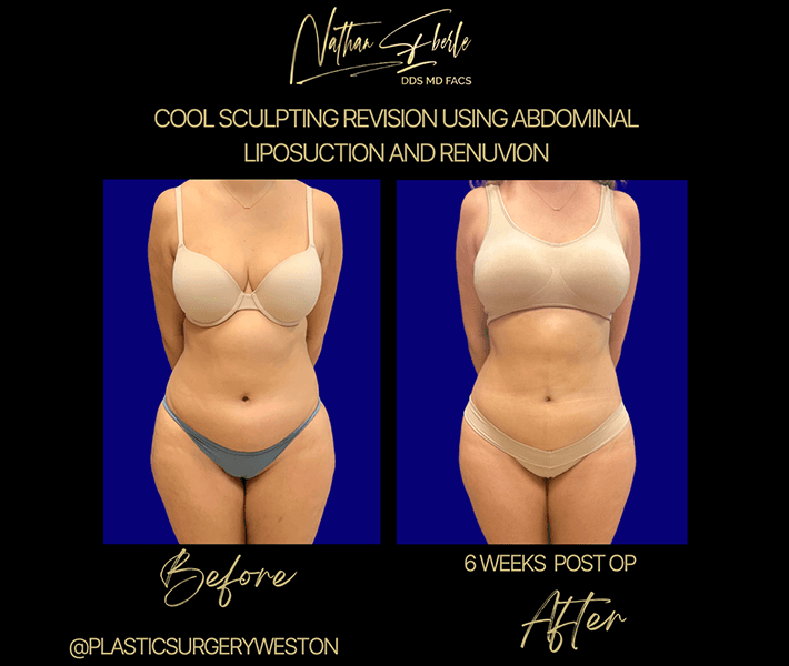Liposuction before and after case 14, actual patient at Weston Center for Plastic Surgery