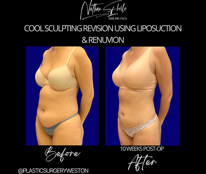 Liposuction before and after case 15, actual patient at Weston Center for Plastic Surgery
