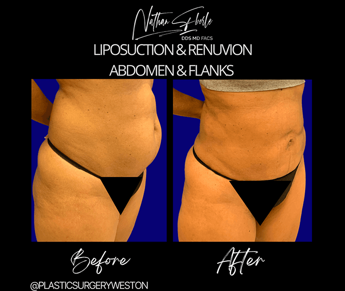 Liposuction before and after case 16, actual patient at Weston Center for Plastic Surgery
