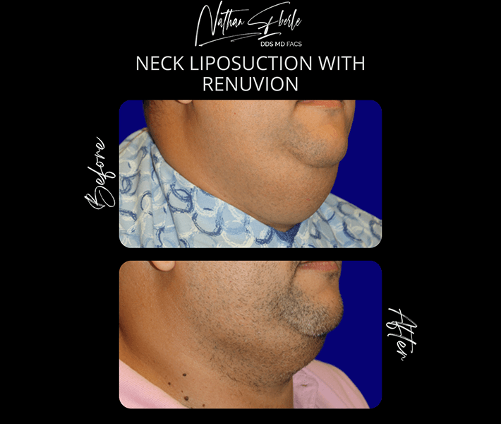 Liposuction before and after case 17, actual patient at Weston Center for Plastic Surgery