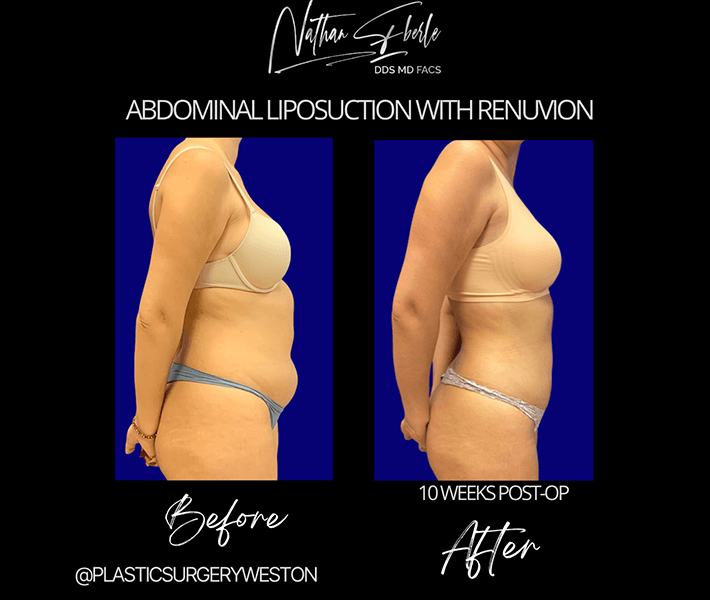 Liposuction before and after case 18, actual patient at Weston Center for Plastic Surgery