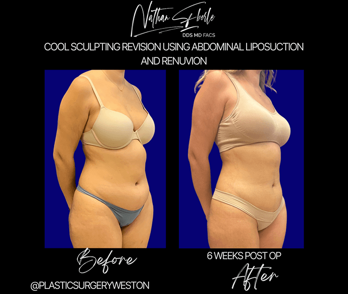 Liposuction before and after case 20, actual patient at Weston Center for Plastic Surgery