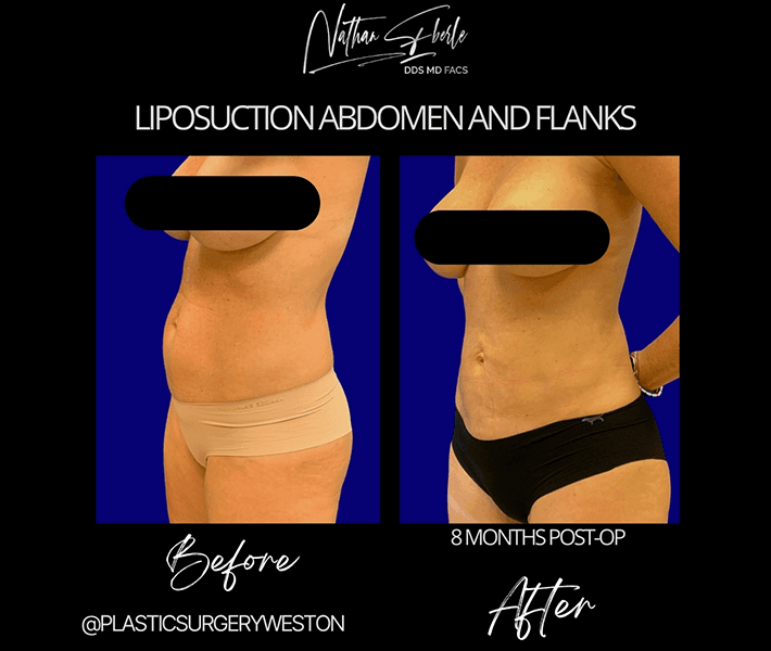 Liposuction before and after case 28, actual patient at Weston Center for Plastic Surgery