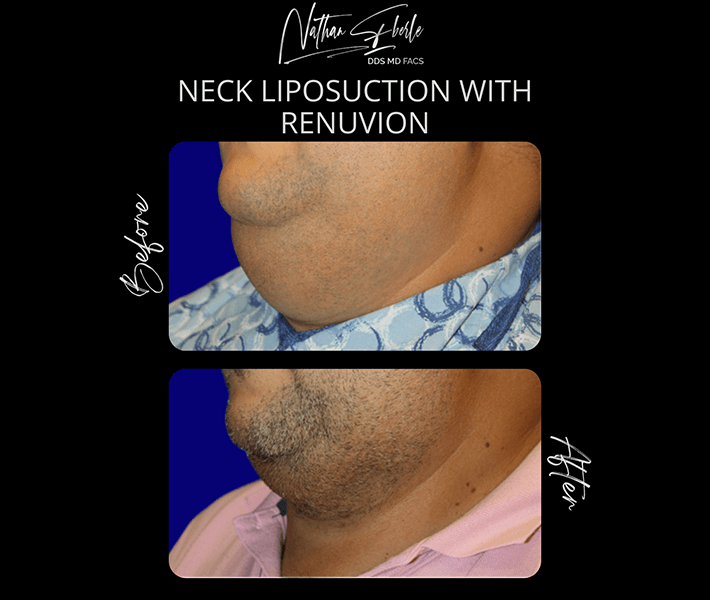 Liposuction before and after case 29, actual patient at Weston Center for Plastic Surgery