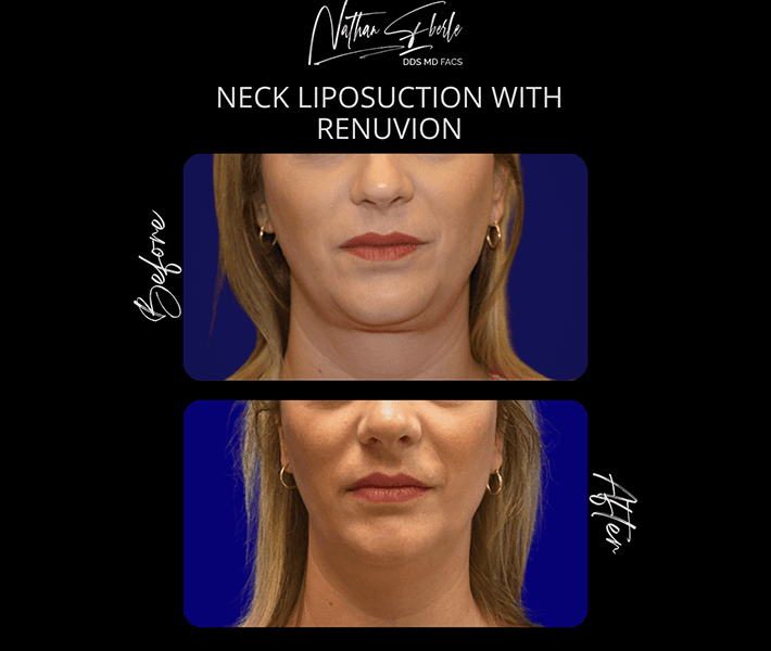 Liposuction before and after case 31, actual patient at Weston Center for Plastic Surgery