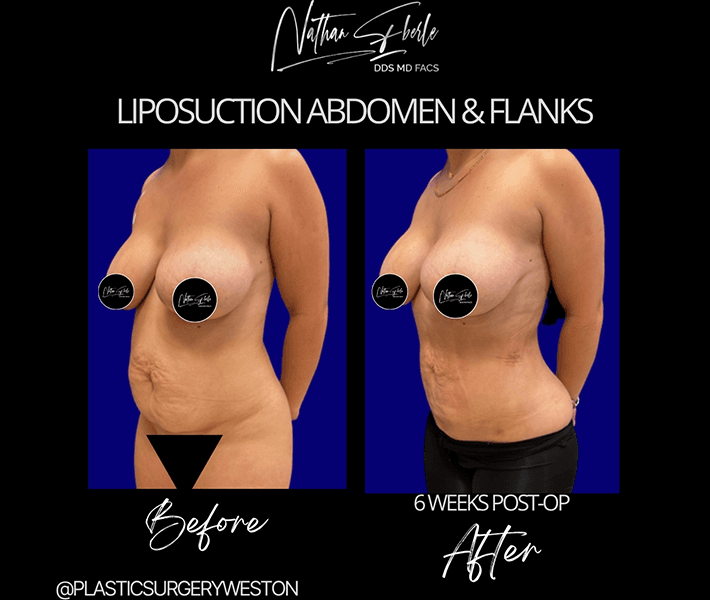 Liposuction before and after case 34, actual patient at Weston Center for Plastic Surgery