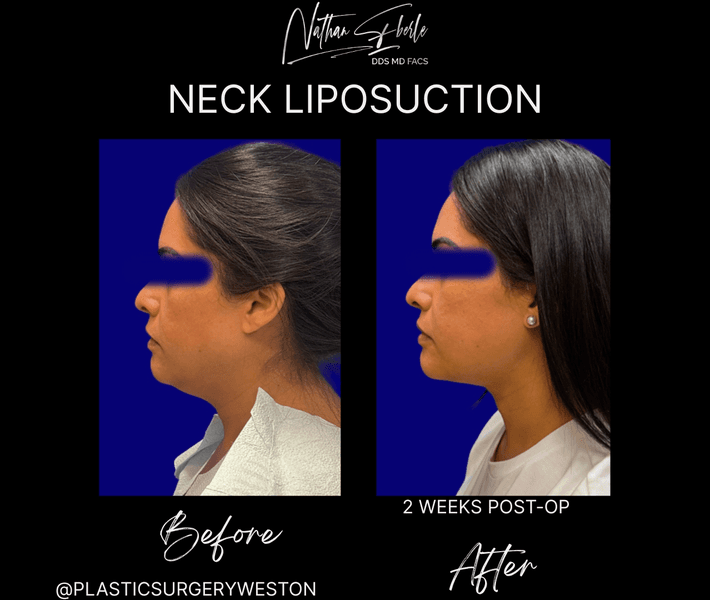 Liposuction before and after case 78, actual patient at Weston Center for Plastic Surgery