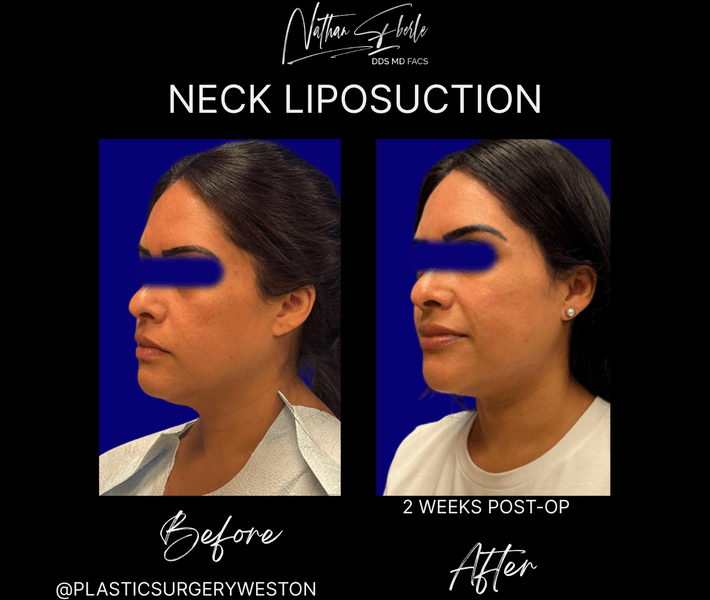 Liposuction before and after case 79, actual patient at Weston Center for Plastic Surgery