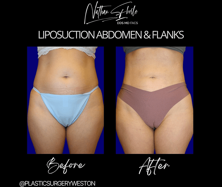 Liposuction before and after case 8, actual patient at Weston Center for Plastic Surgery
