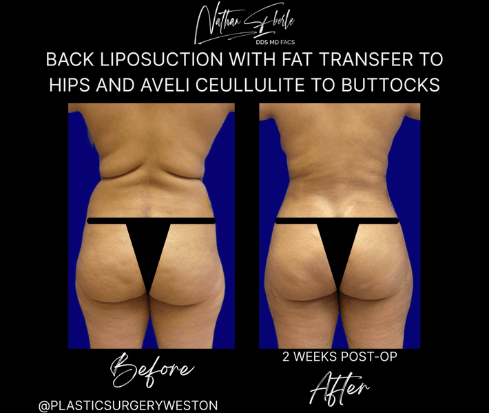 Liposuction before and after case 80, actual patient at Weston Center for Plastic Surgery