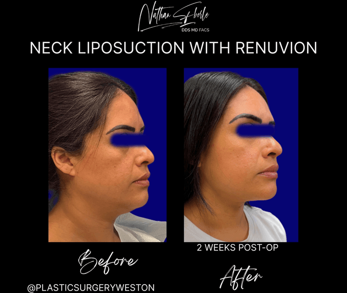Liposuction before and after case 81, actual patient at Weston Center for Plastic Surgery
