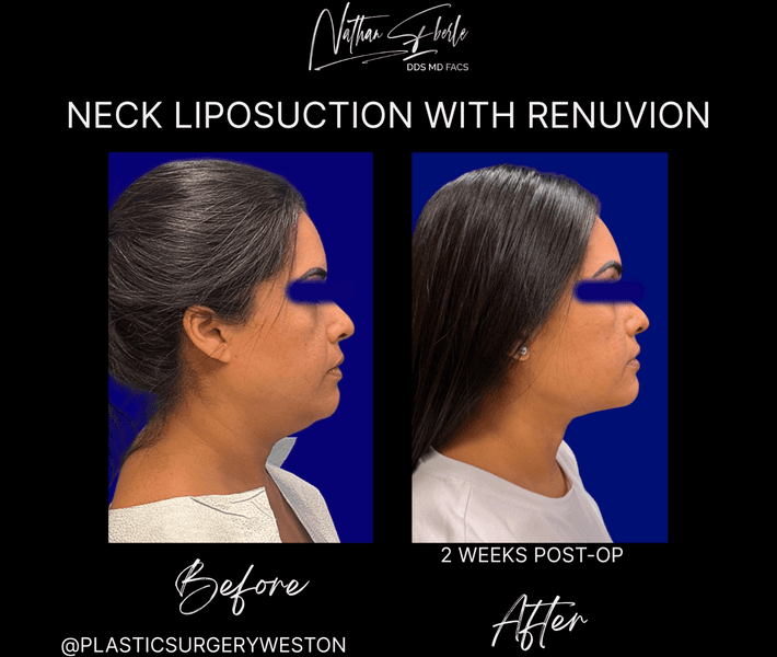 Liposuction before and after case 82, actual patient at Weston Center for Plastic Surgery