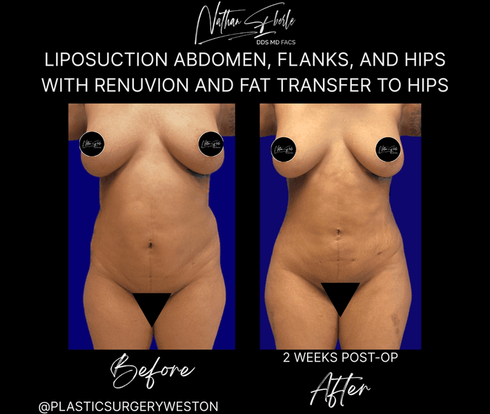 Liposuction before and after case 83, actual patient at Weston Center for Plastic Surgery