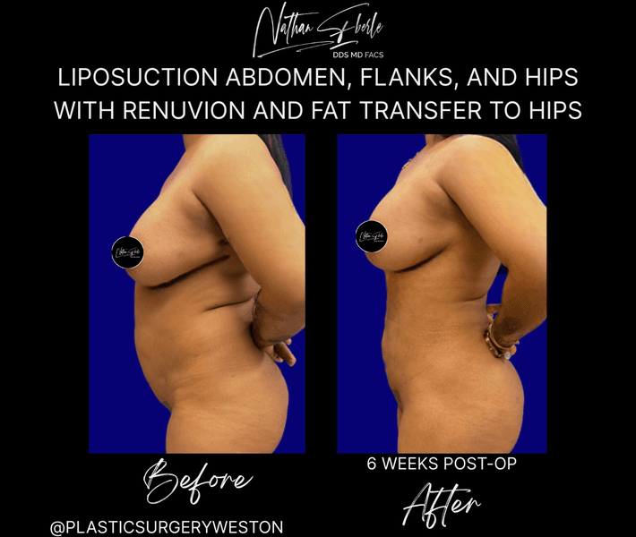 Liposuction before and after case 84, actual patient at Weston Center for Plastic Surgery
