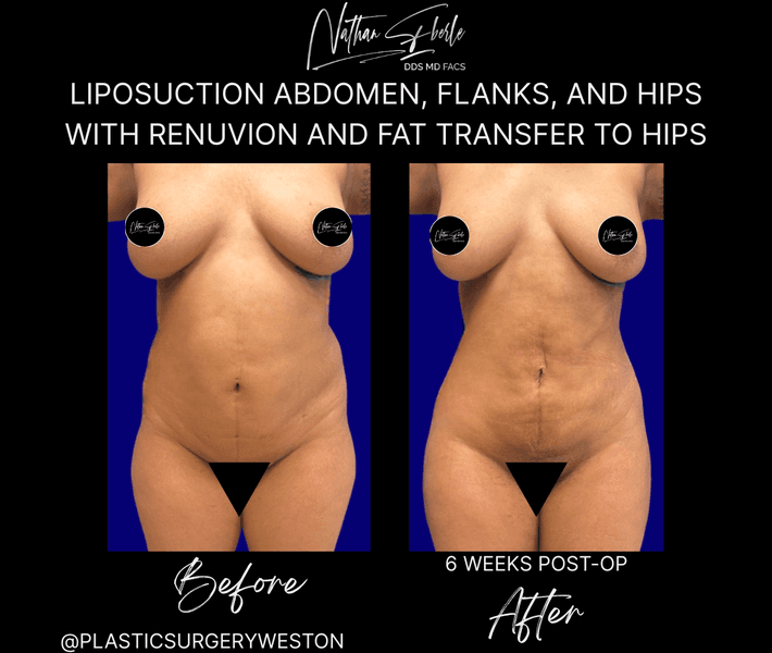 Liposuction before and after case 85, actual patient at Weston Center for Plastic Surgery