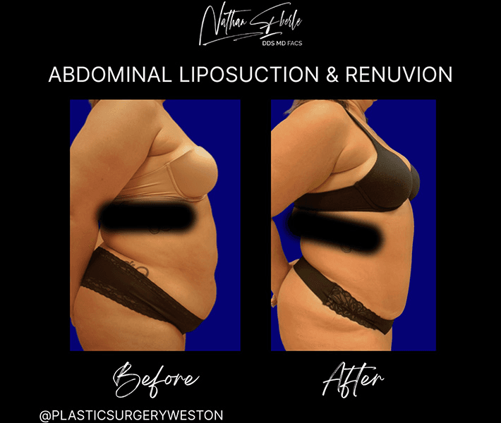 Liposuction before and after case 86, actual patient at Weston Center for Plastic Surgery
