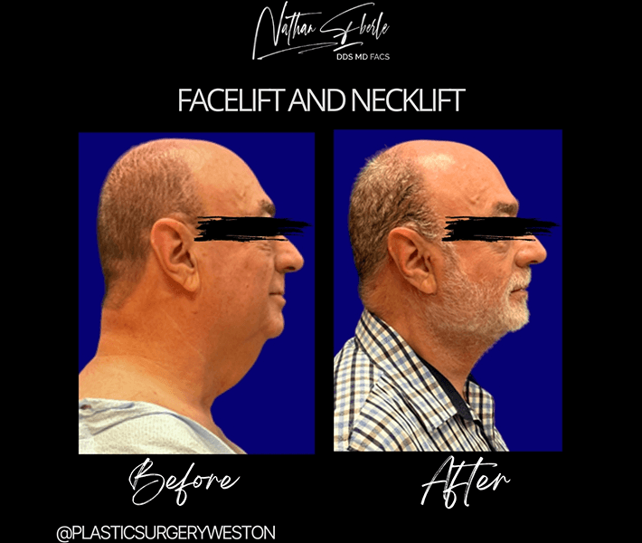 Neck Lift before and after case 10, actual patient at Weston Center for Plastic Surgery