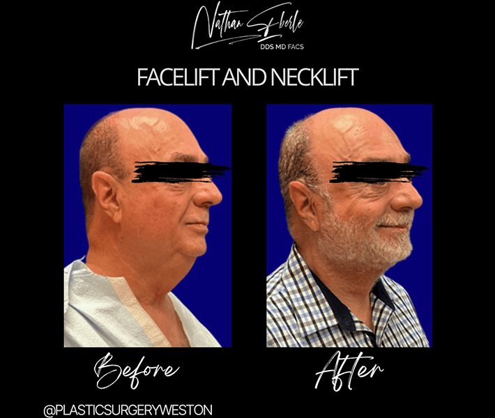 Neck Lift before and after case 13, actual patient at Weston Center for Plastic Surgery
