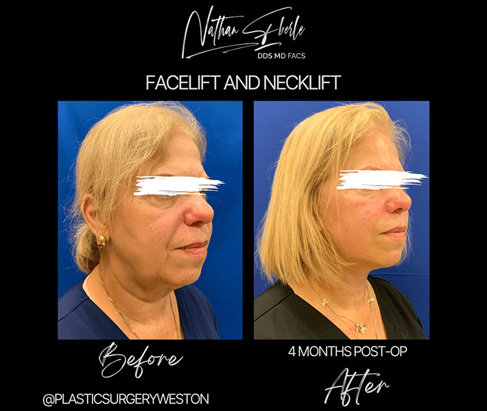 Neck Lift before and after case 17, actual patient at Weston Center for Plastic Surgery